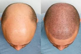 Regain Your Confidence: Hair Transplant in Dubai Made Easy