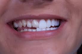 Is Veneer Treatment Right for You? Pros, Cons, and Costs